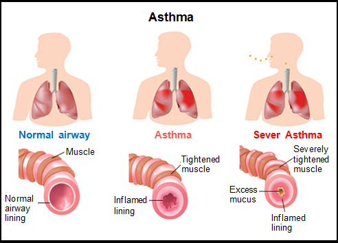 1-a-asthma-definition