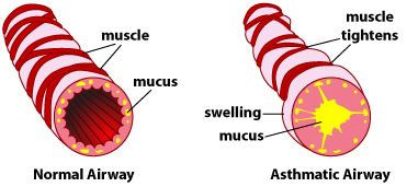 asthma-airways-mucus